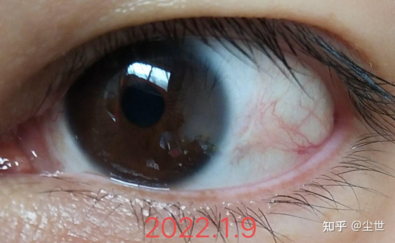 眼睛色素痣手术治疗记录