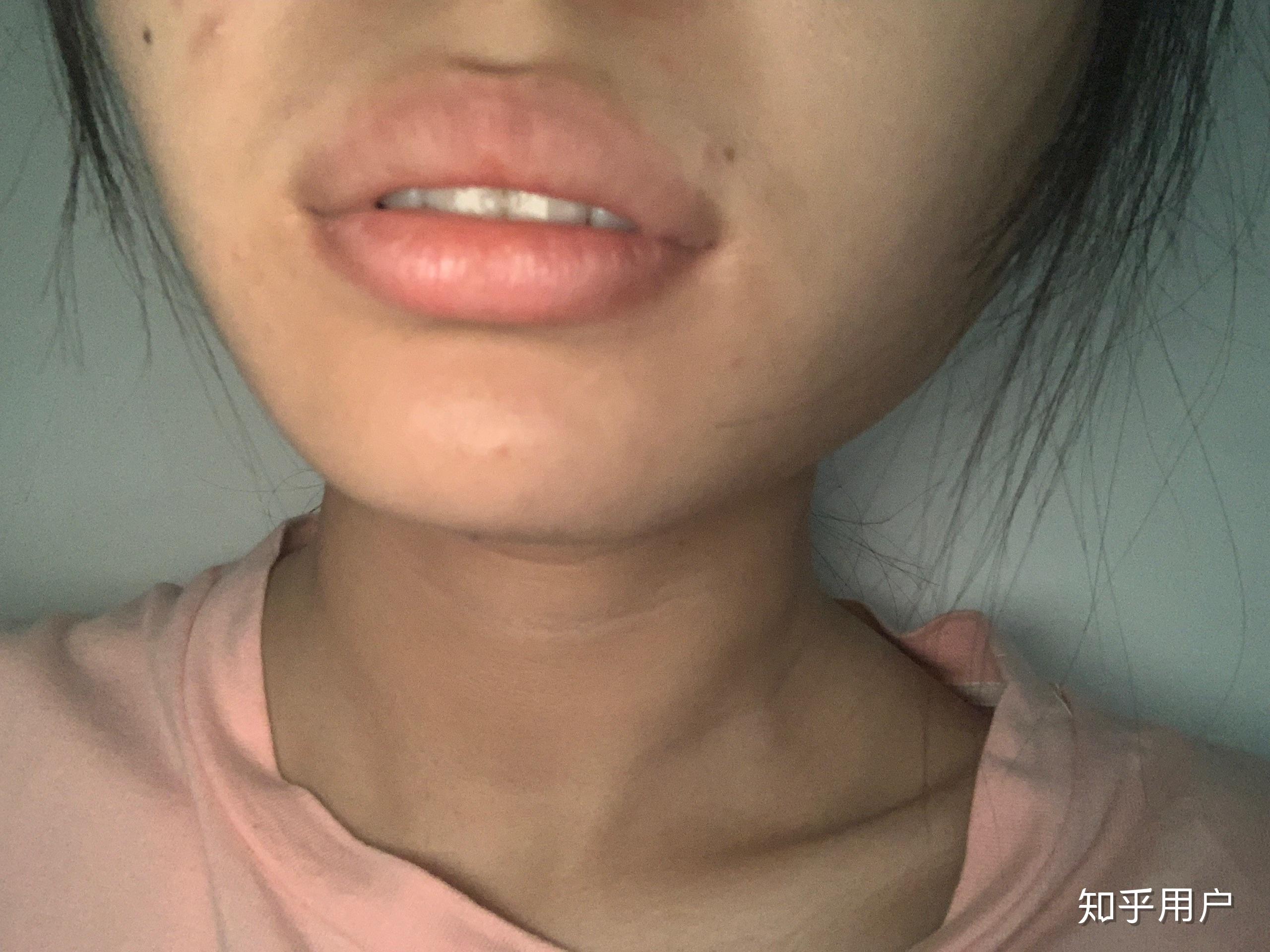 嘴唇厚而且外翻真的超级丑? - 知乎