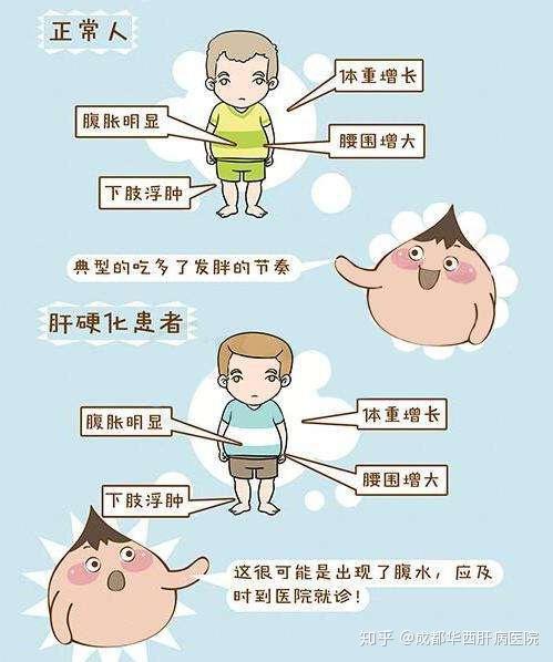 肝硬化腹水能活多长