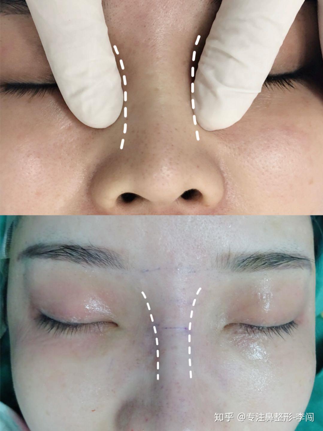有鼻骨宽的做鼻骨内推手术的吗