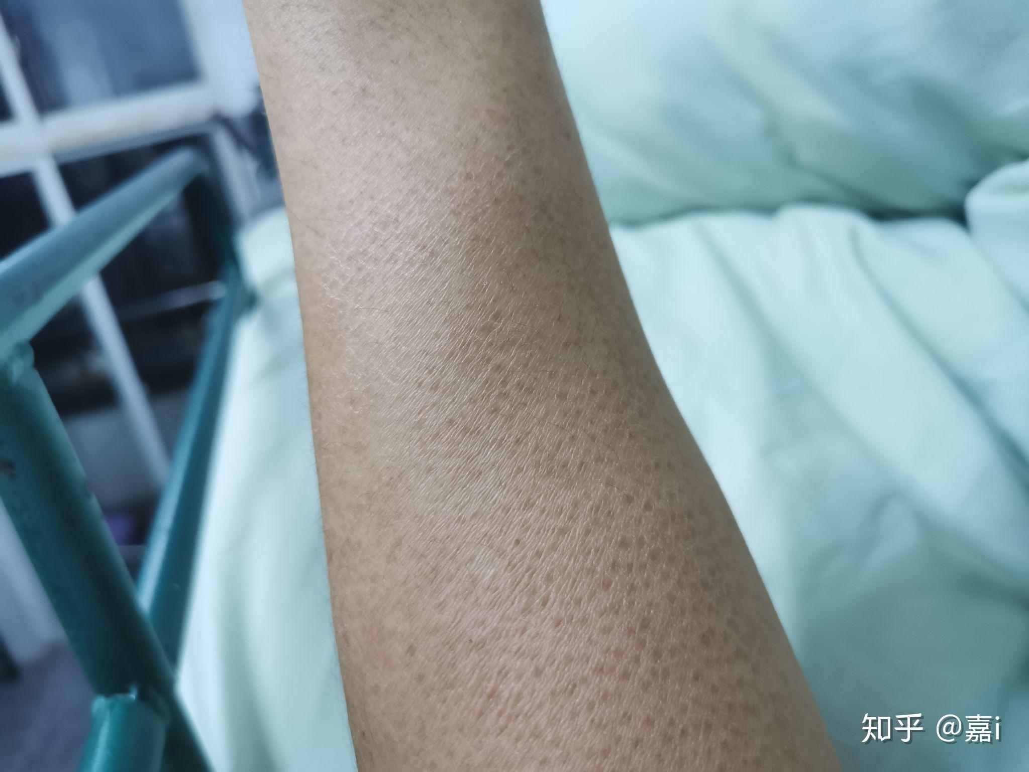 毛孔角化症怎么消除?