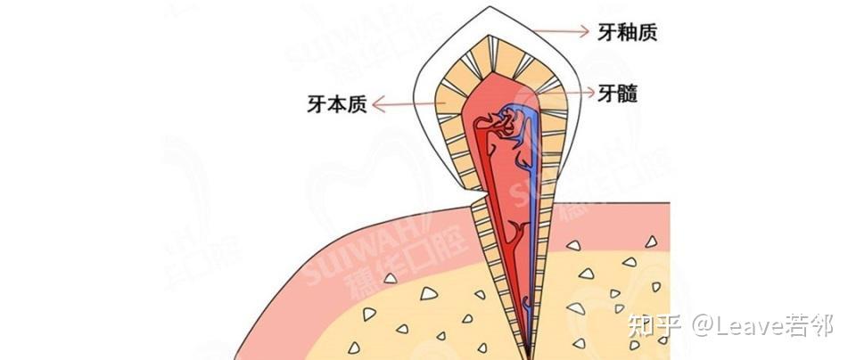 楔状缺损画图图片