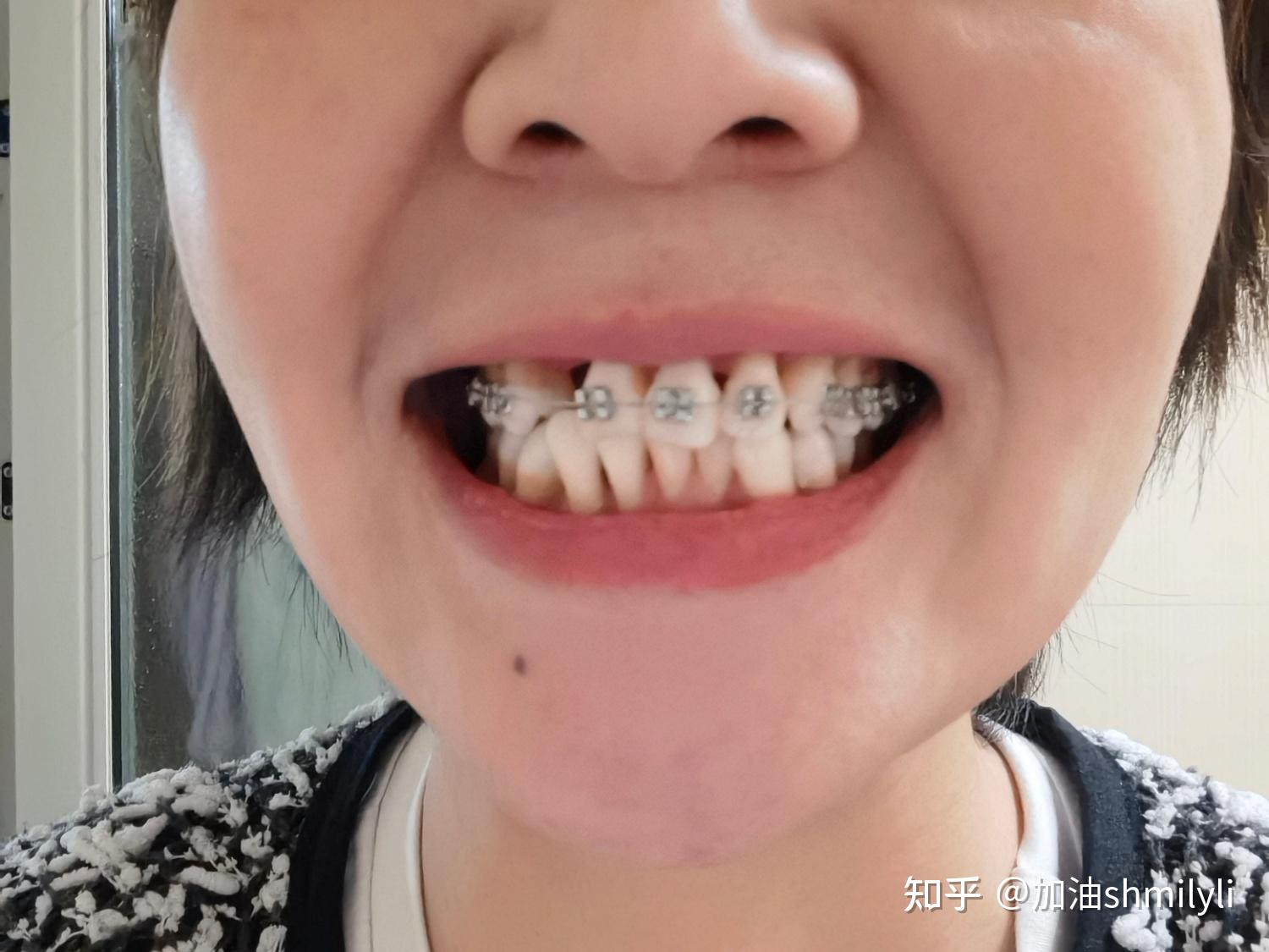 北大口腔：牙周治疗-种牙-正畸-种牙的漫长过程 - 知乎