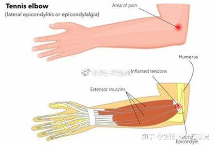 运动康复科普 肘关节损伤的常见类型与急性处理方法 知乎