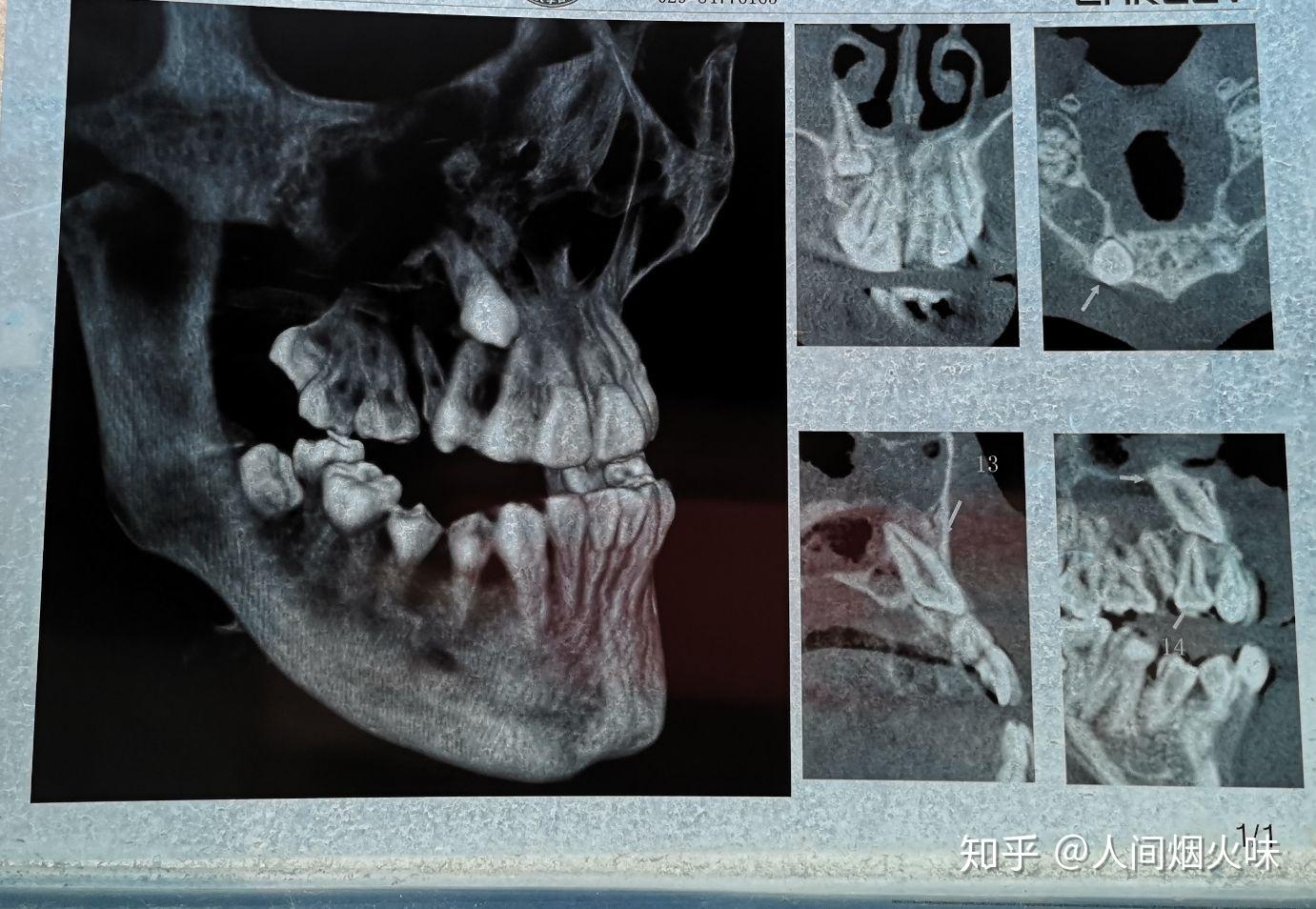 这样的上颌埋伏牙,拔出难度大吗?风险呢?