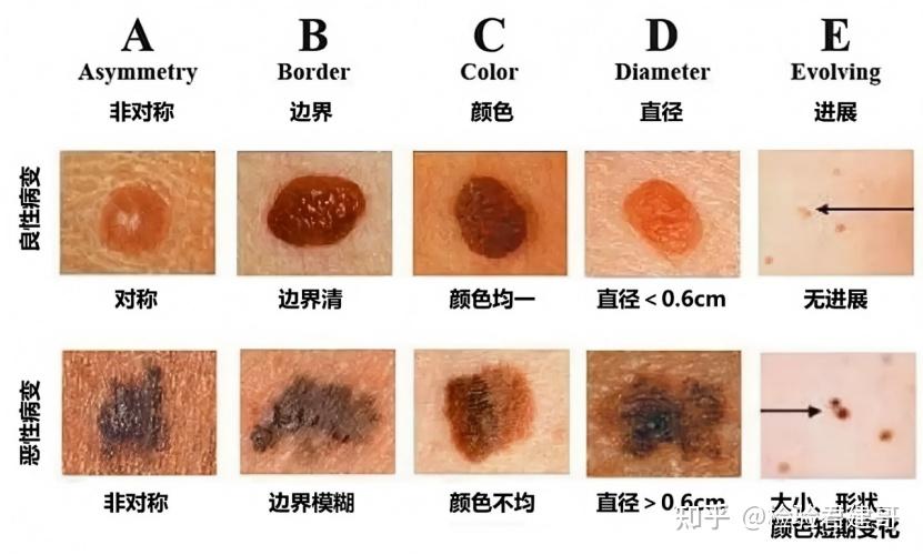 再次提醒:长在5个部位的痣,与癌症“息息相关”,要及时处理 - 知乎
