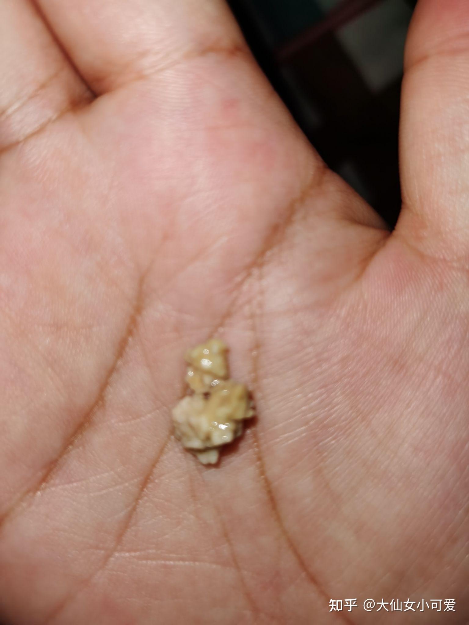 你见过最大的扁桃体结石有多大? - 知乎