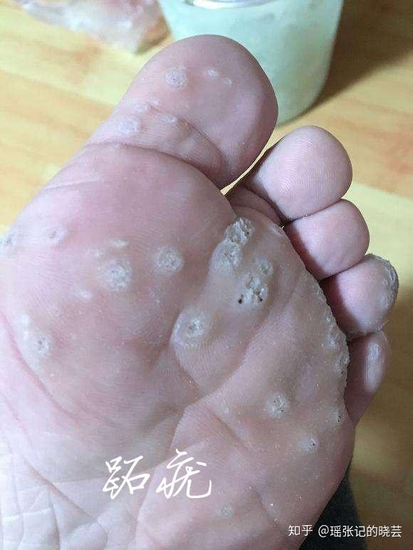 为什么宝宝脚上会长鸡眼,日常该如何护理?