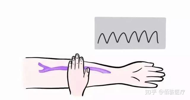 通畅的内瘘用手触摸吻合口附近时有较明显的震颤与波动,将造瘘的手臂