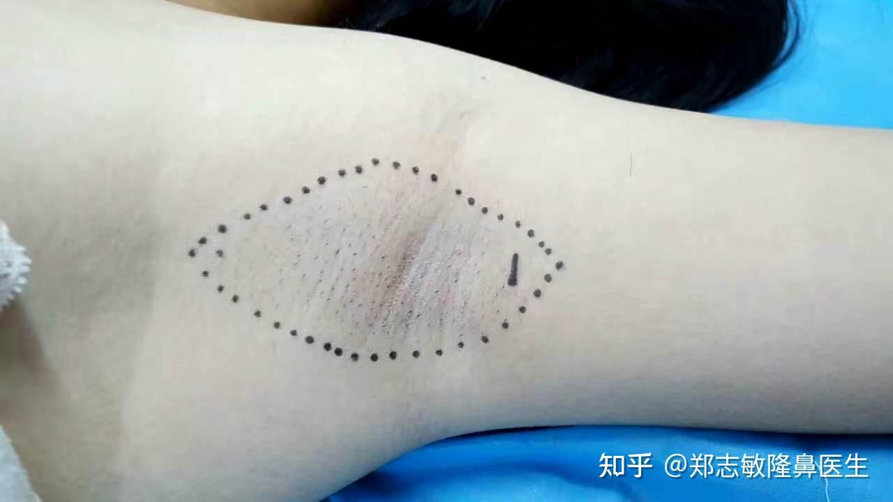 有什么靠谱的去腋臭(狐臭)的方法吗？ - 知乎