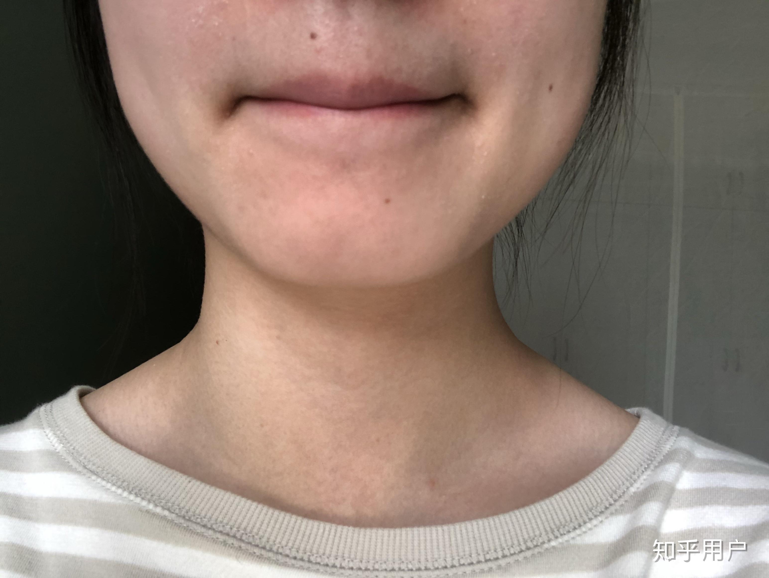 有做过冰点脱唇毛的小姐姐,想知道痛不痛,脱完还会长吗? - 知乎