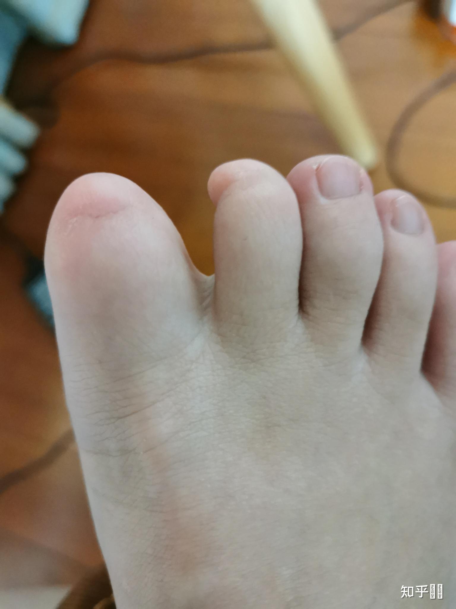 人类如果没有脚指甲会怎样?