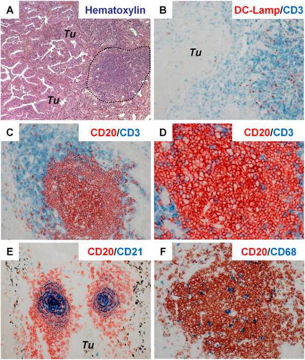 三级淋巴结构在肿瘤微环境中的作用 - 知乎