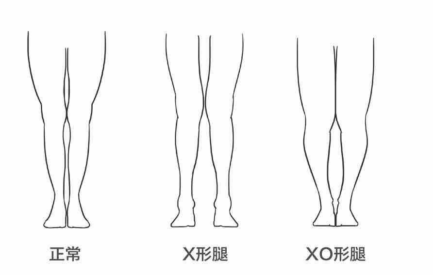 如何判断xo型腿的成因及合适的运动矫正方法