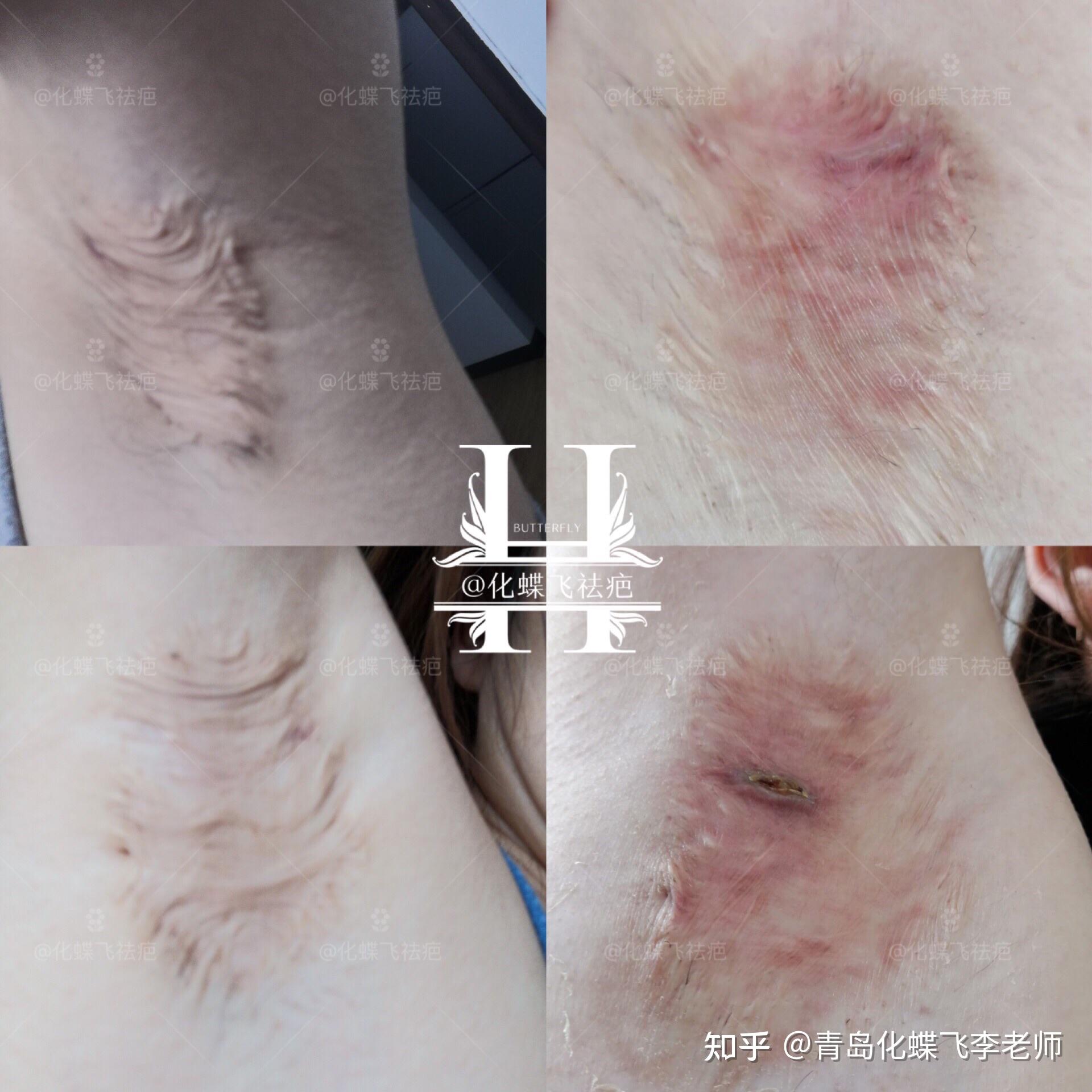 湖北严重的腋下手术疤痕