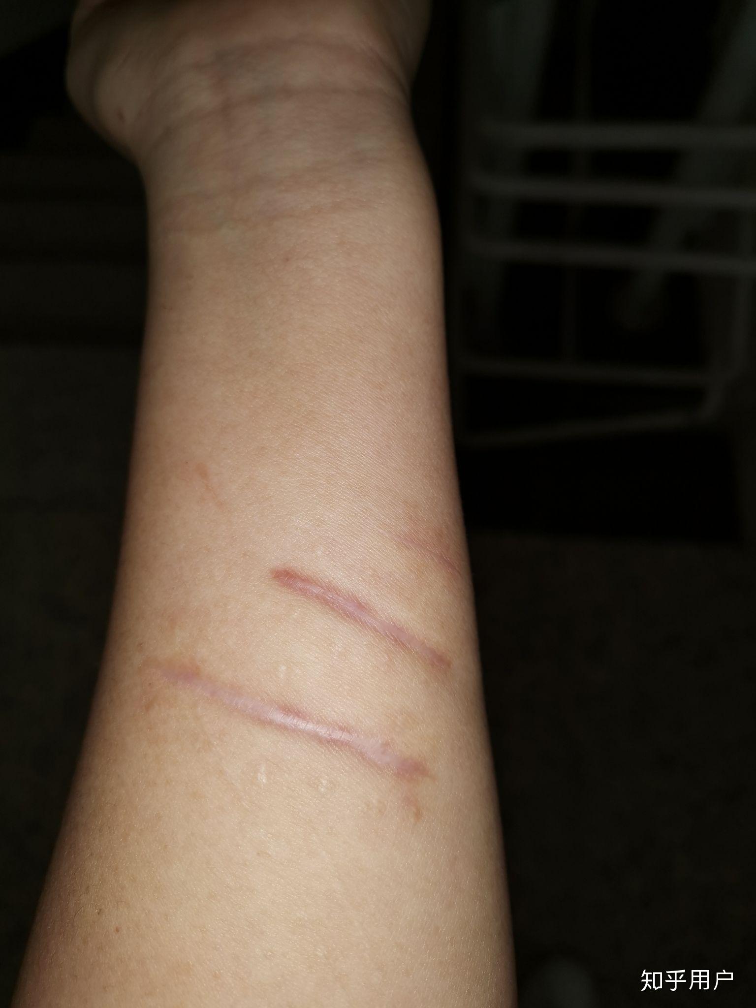 怎么遮自残的伤疤