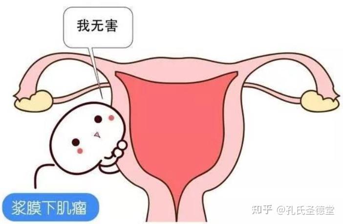 女性健康天敵子宮肌瘤你瞭解多少