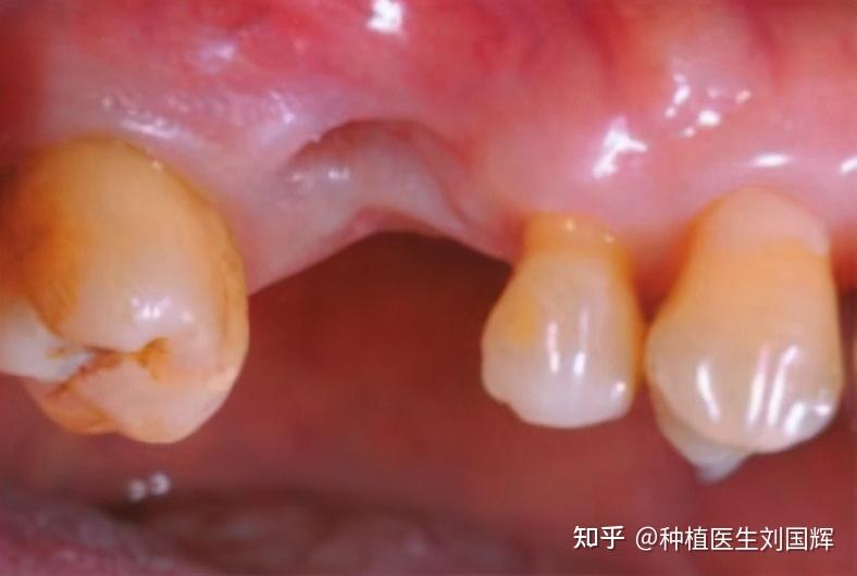 拔完智齿两三周了为什么拔牙洞还在要多久才能消失