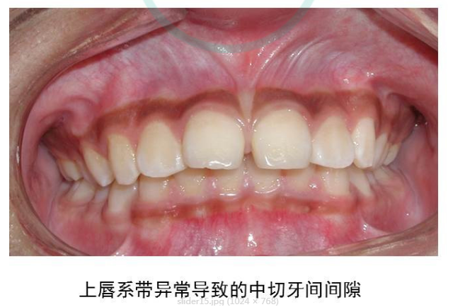上下大牙咬合不正 医生建议使用扩弓器先扩上牙 再用上牙牵引下牙,这