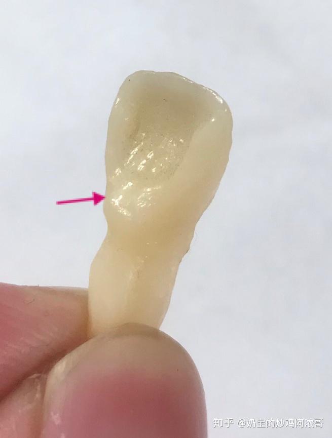 为什么有人说大部分中国人门牙背面都是凹下去的? - 知乎