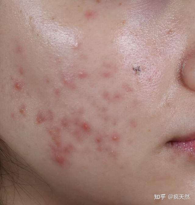开口闭口型粉刺怎么办? - 知乎
