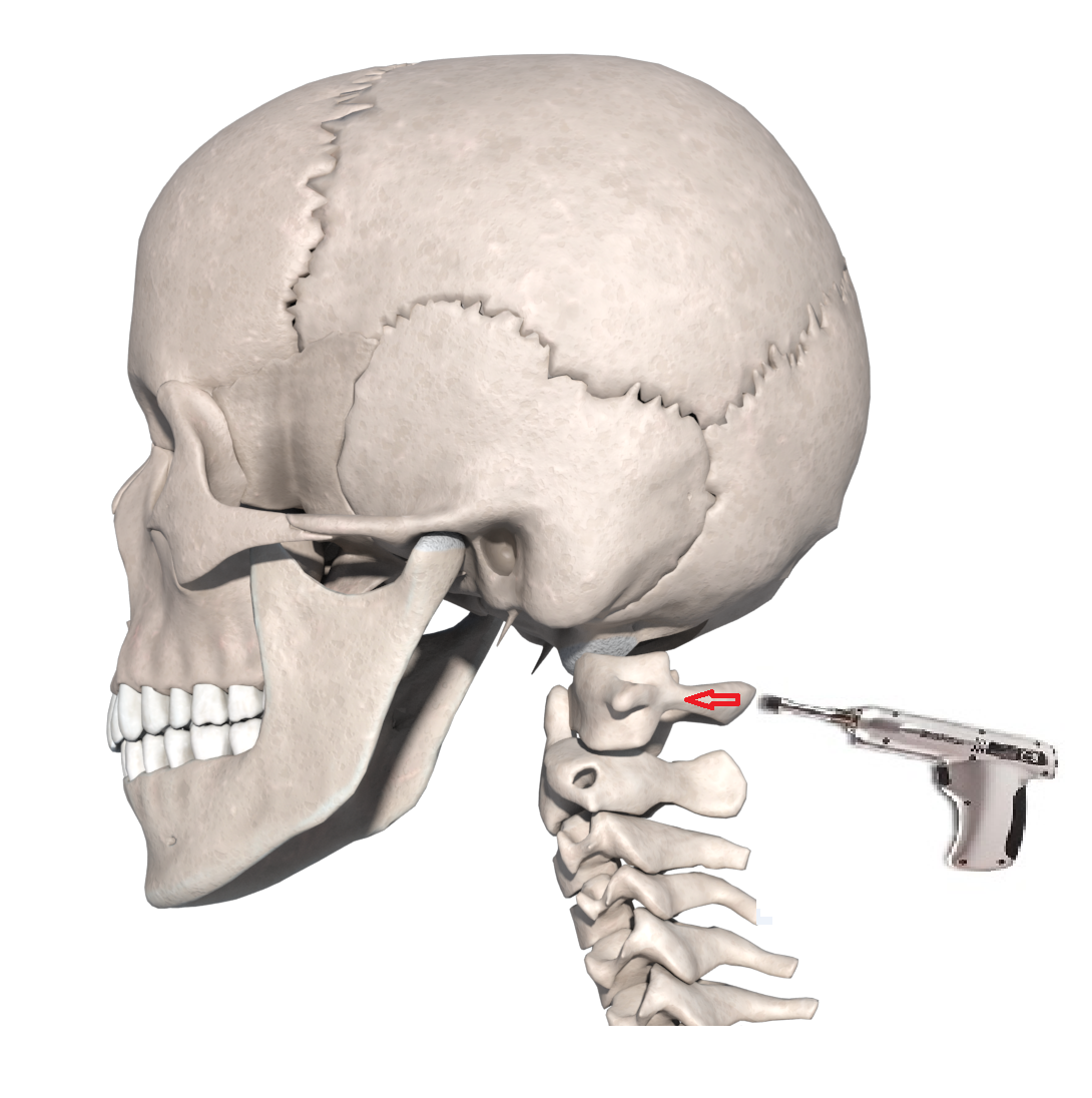 患者仰卧位,治疗师用中指反复触诊枕骨隆凸下方的枕外嵴和寰椎后结节