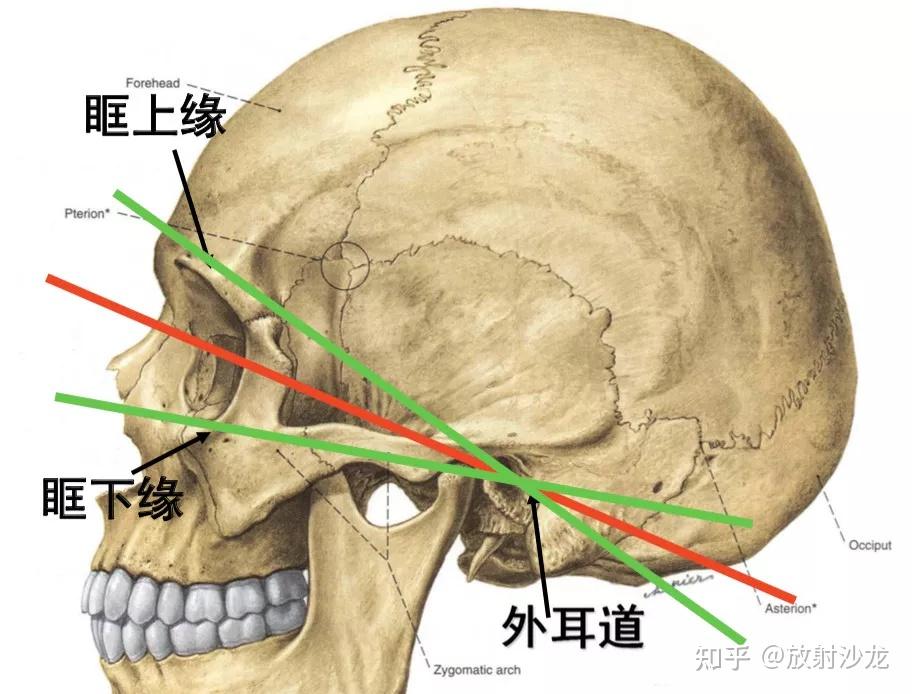 為外耳道中點與眶上緣中點的連線,經該線的平面約與顱底平面一致,有