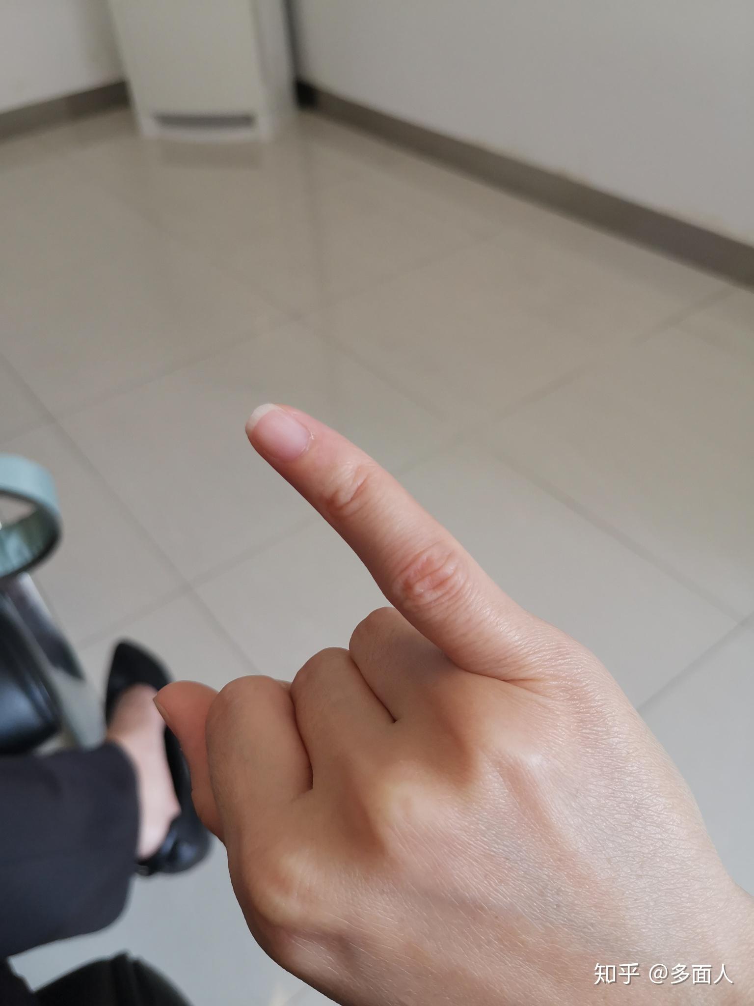 手指弯曲是什么原因造成的