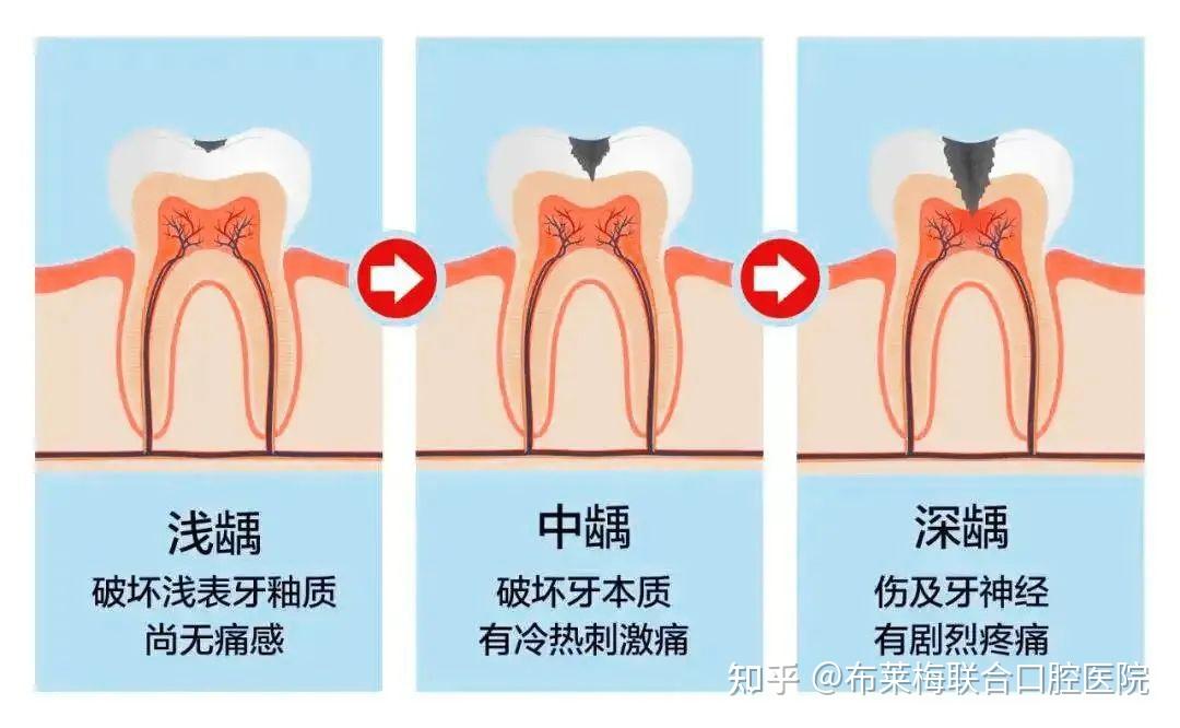 牙齿莫名其妙就缺损了一块,这到底是啥情况?