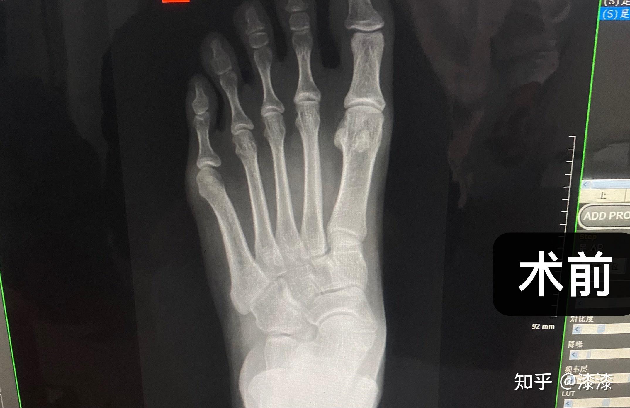 新疆乌鲁木齐大脚骨手术矫正案例 | 大脚骨手术，拇外翻微创矫正|从2004年起专业矫正大脚骨