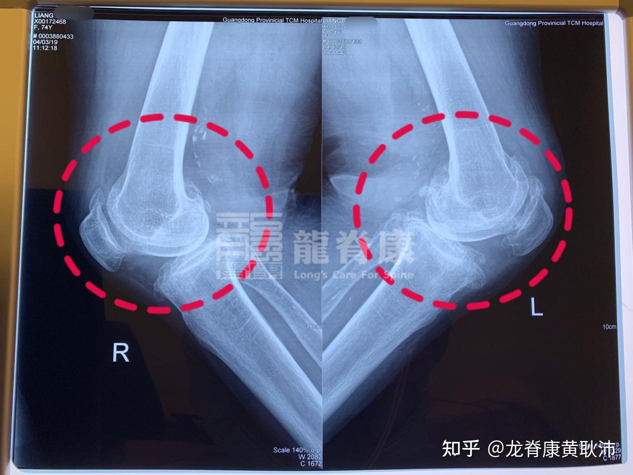 双膝髌骨,胫骨平台及股骨内外侧髁软骨及远端后方肌腱均可见钙化影