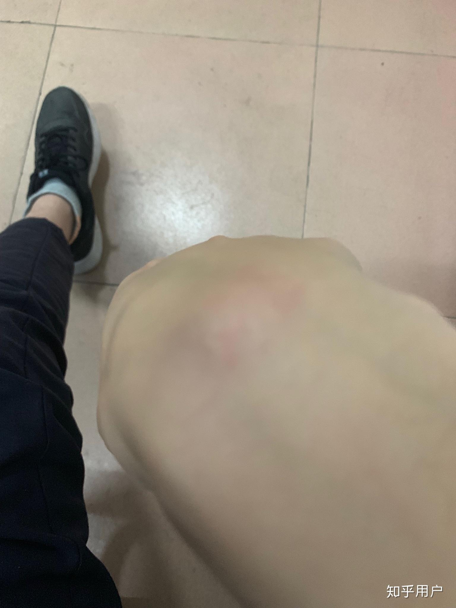 手腕弯下去手背上骨头凸起是怎么回事