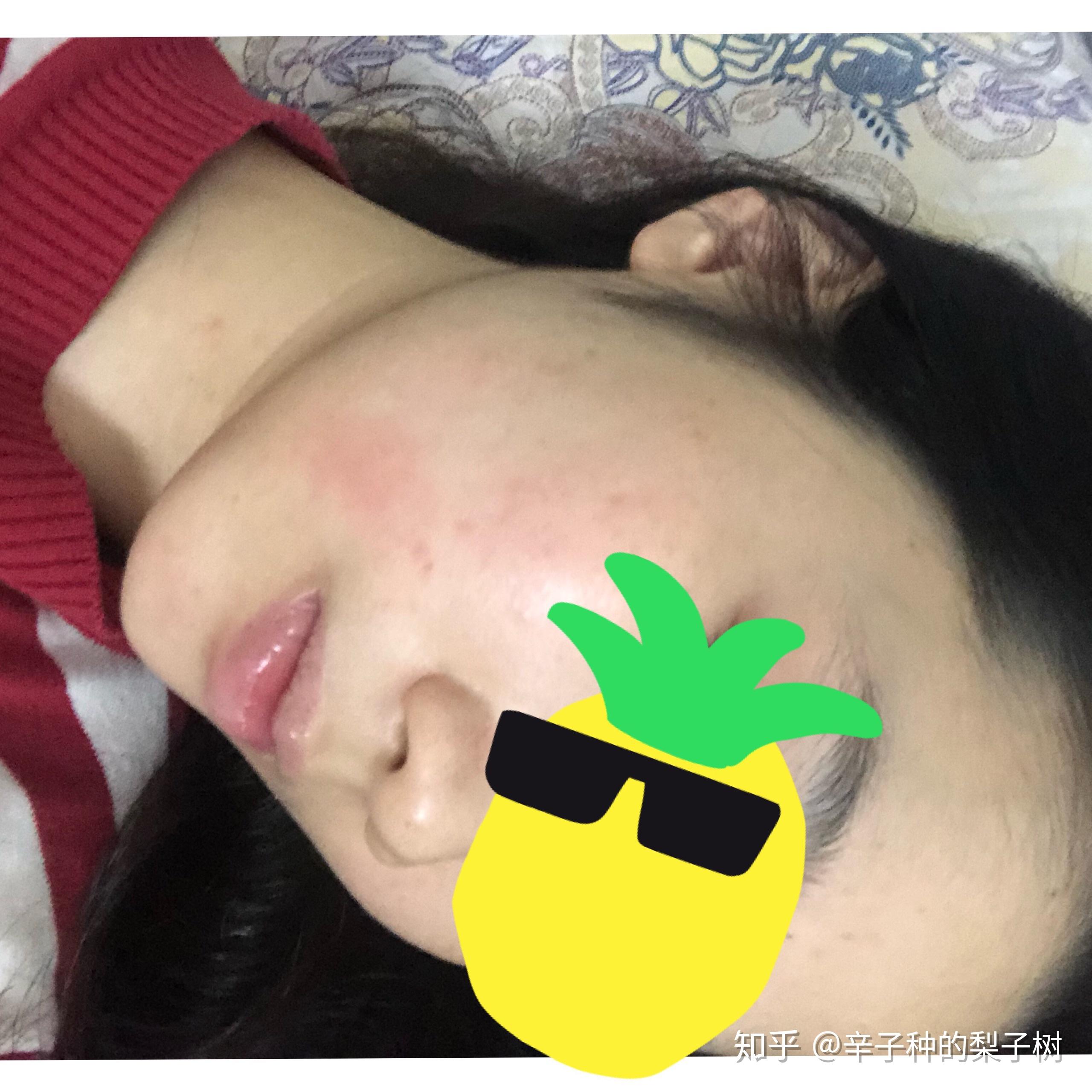 左脸发红比较厉害:3月17日左右,当时去忍不住了才去看医生说是过敏了