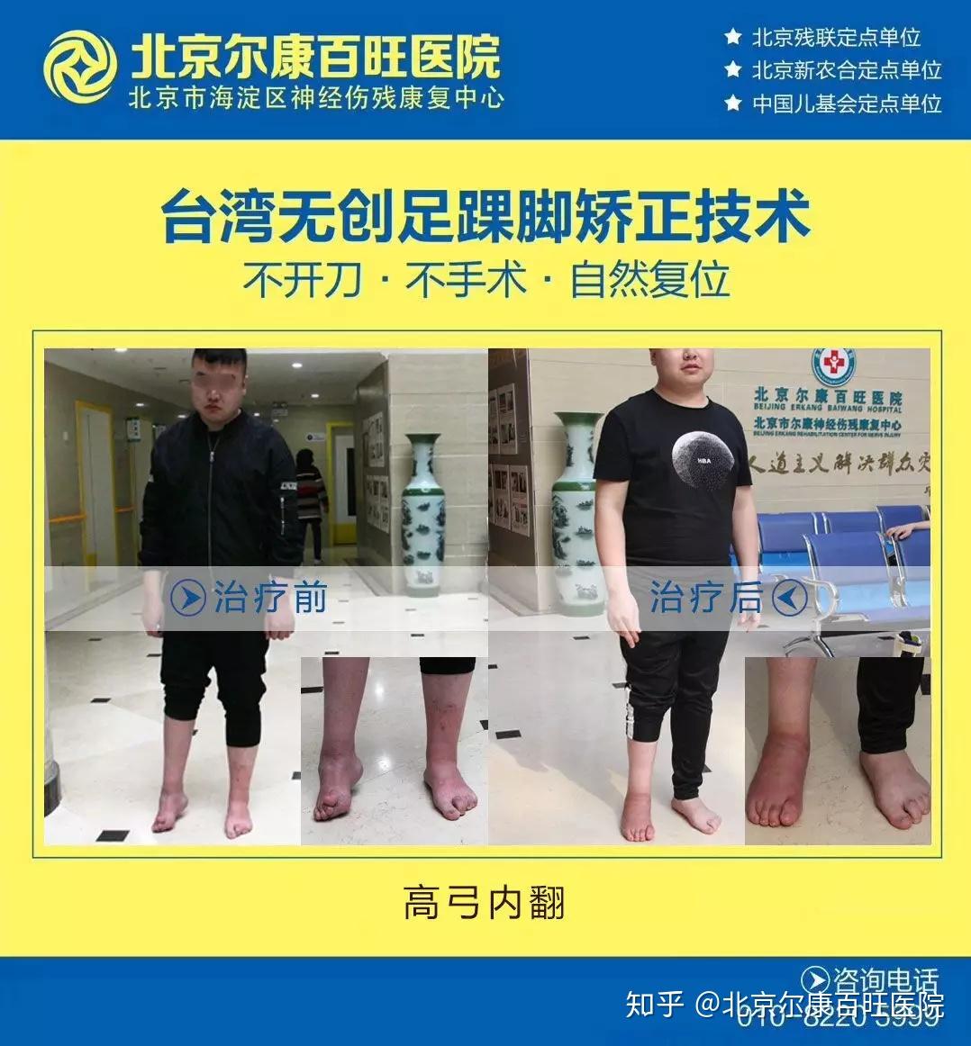 提示高弓足的治疗要尽早,选择专业的医院治疗,避免治疗过晚导致并发症