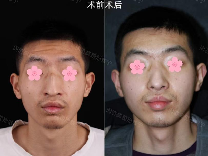 为什么鼻梁中间突出了一块骨头?