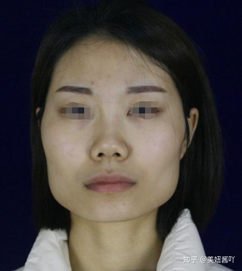 因为方脸脸宽下颌骨肥大而自卑怎么办该不该削骨