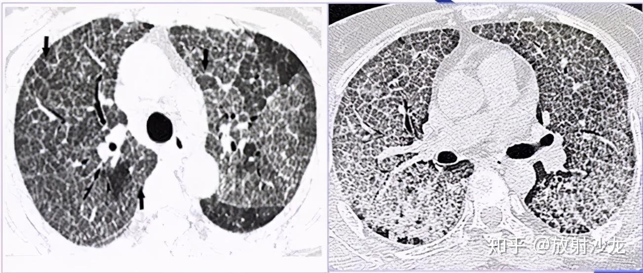 碎石路徵:肺泡蛋白沉著症(pap)ct徵象九:空氣新月徵肺內空洞或空腔內