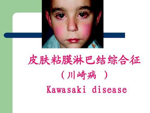 2年内孩子遭受2次川崎病（一） - 知乎