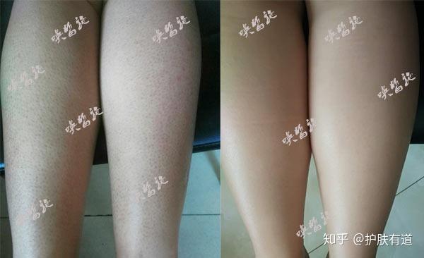 鸡皮肤是如何产生的的简单介绍