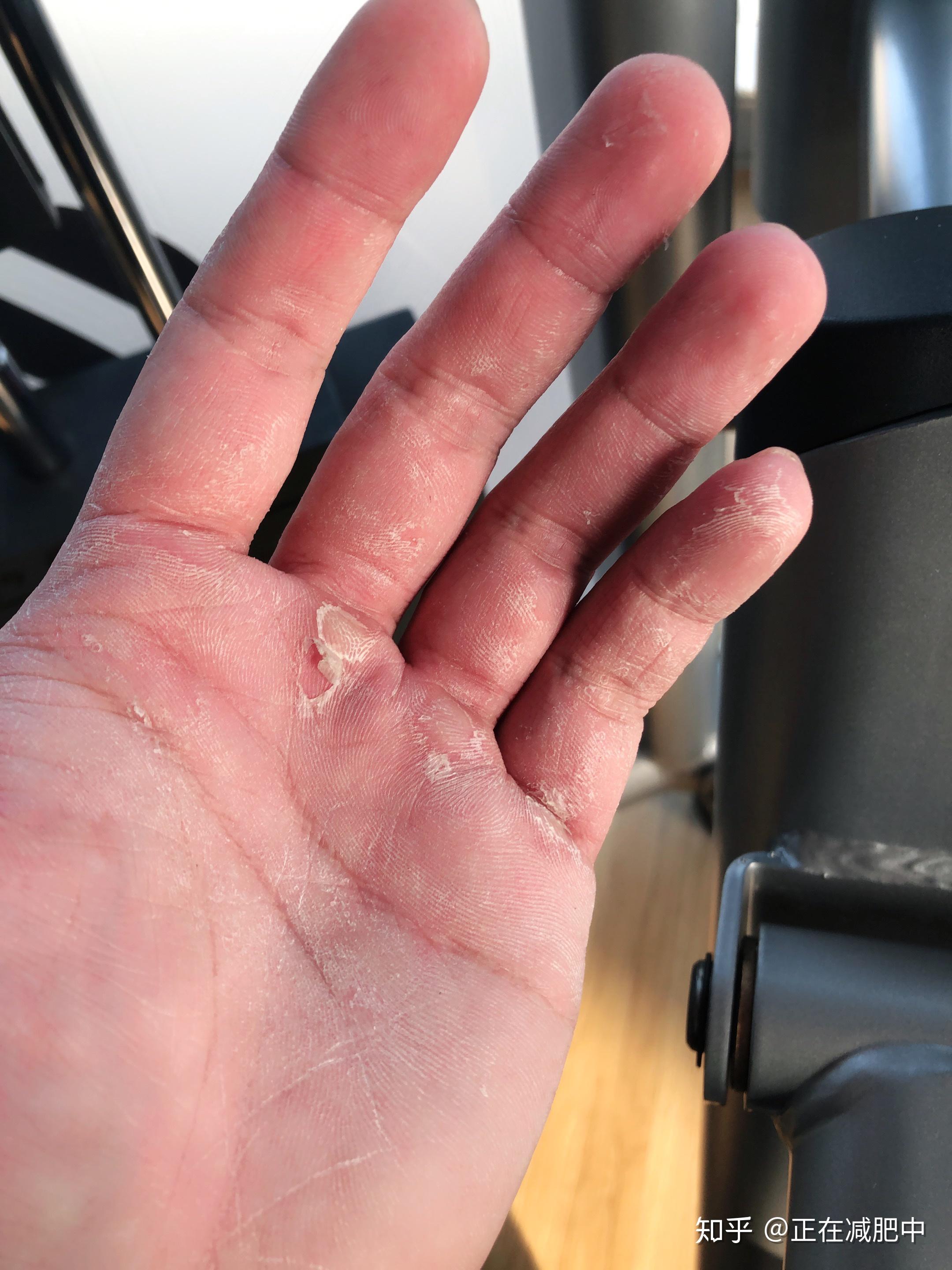 健身手破皮一般怎么处理? - 知乎