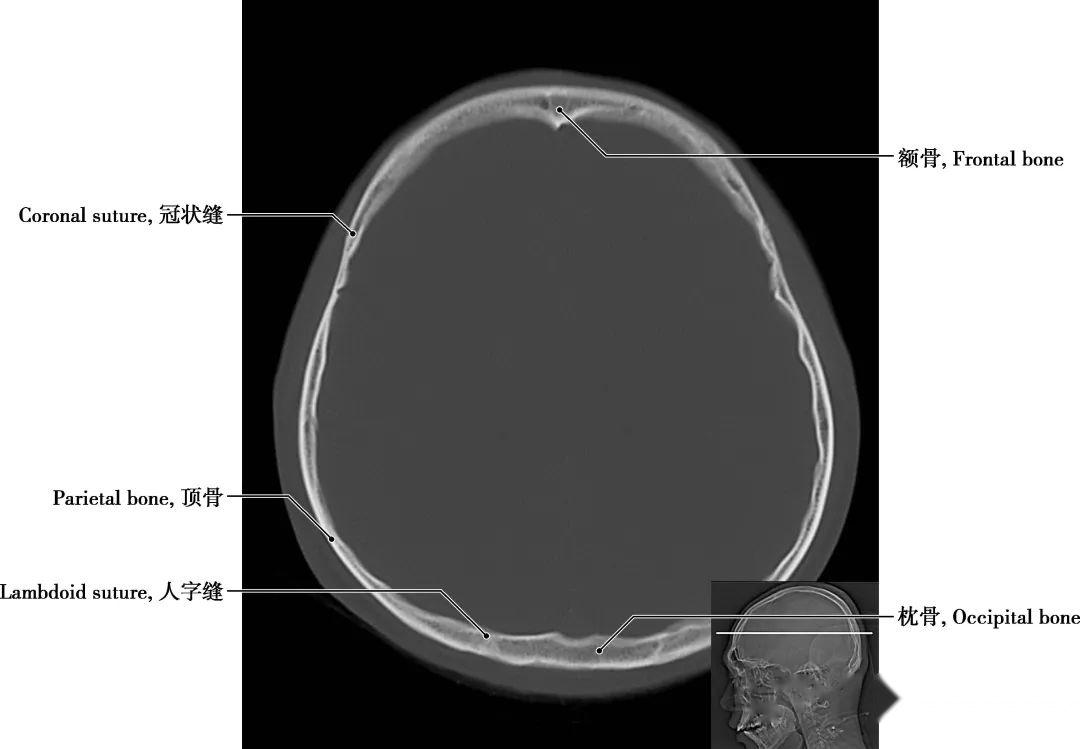 详细标注版!颅脑CT正常解剖图谱 - 知乎