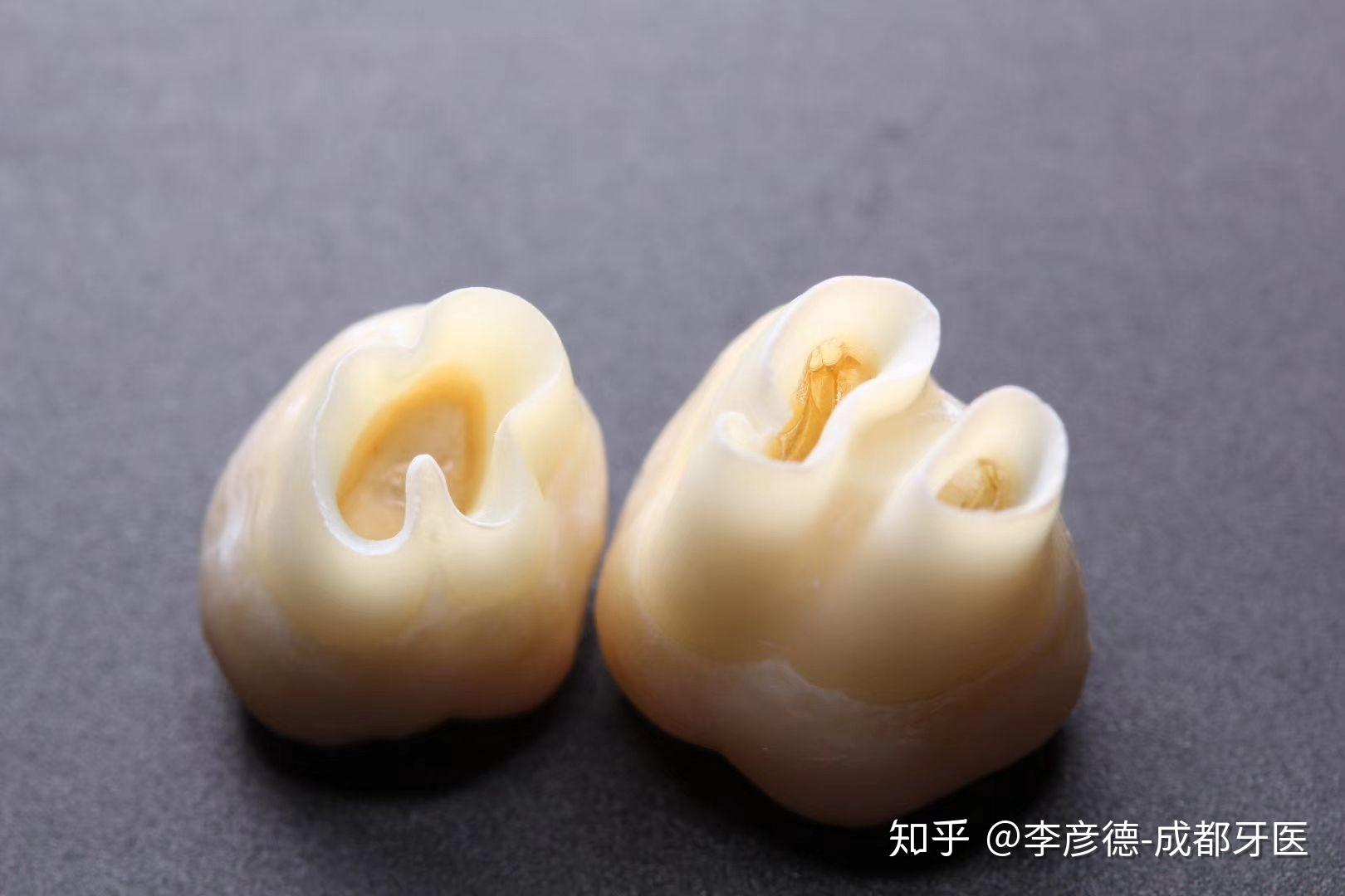 根尖孔未完全形成是什么样的