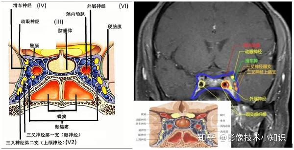 鞍区MRI影像解剖 - 知乎