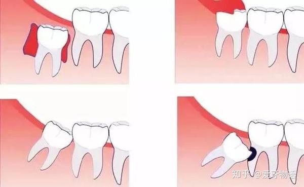 为什么医生都建议拔掉智齿呢 知乎