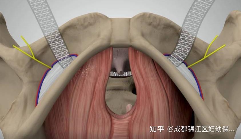 成都锦江妇幼妇科专家指出尿失禁可以通过单切口治疗