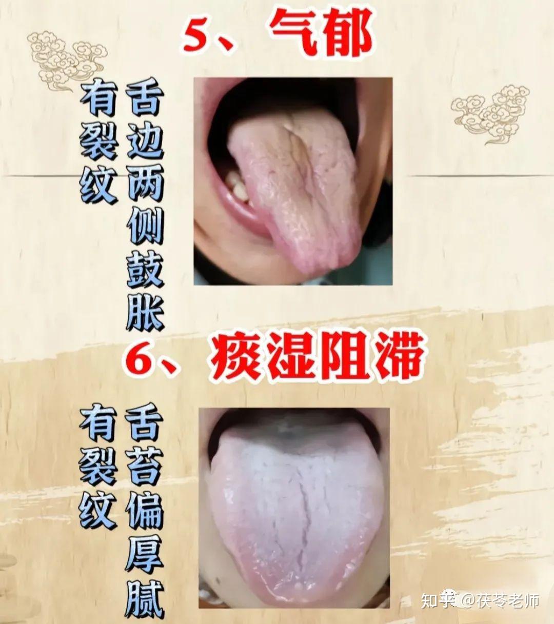 九种舌相裂纹,你属于哪种? - 知乎