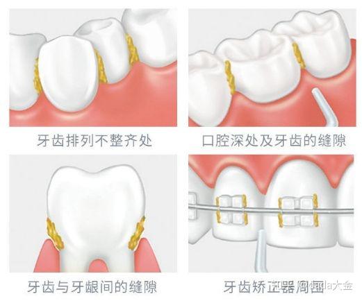 什么情况可以不用正畸直接正颌 v2-b061548e16321d20f84065607afd1aa4_r.jpg