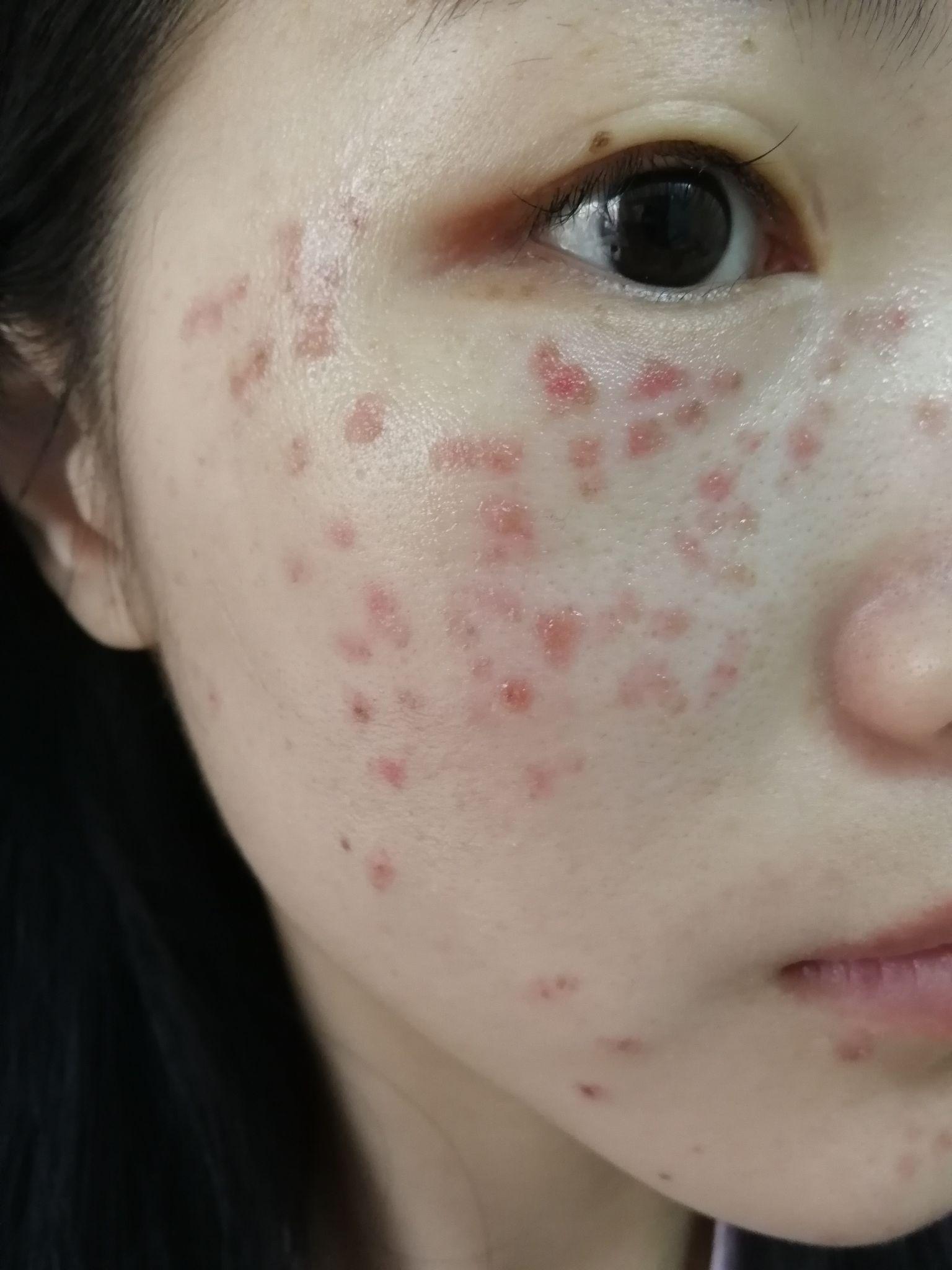 怎么去雀斑,激光祛斑怎么样?