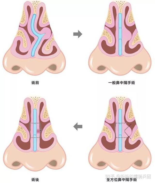 鼻中隔弯曲的原因图片