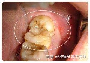 拔完智齿怎么消肿 知乎
